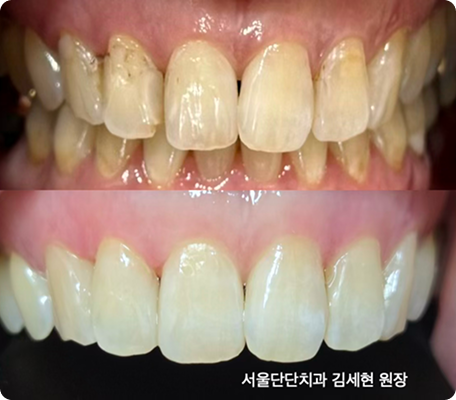 꺼진잇몸을 재건시키는 임플란트 재치료