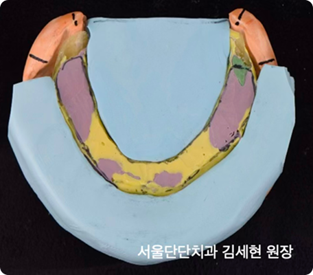 중립대 인상을 통한 혀와 볼이 편한 틀니제작