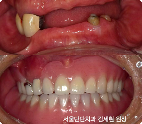 임플란트 1개만 심어서 움직이지 않는 틀니의 완성
